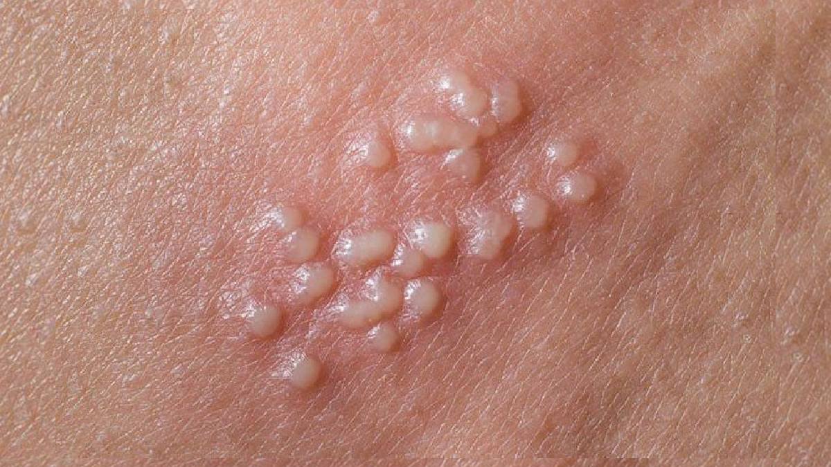 Blisters and flu among the main symptoms of Herpes