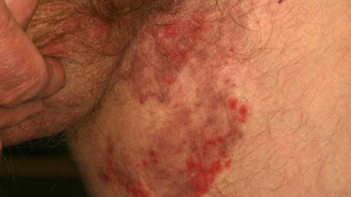 Five Home remedies to get rid of Fungal Skin Infection during Summer