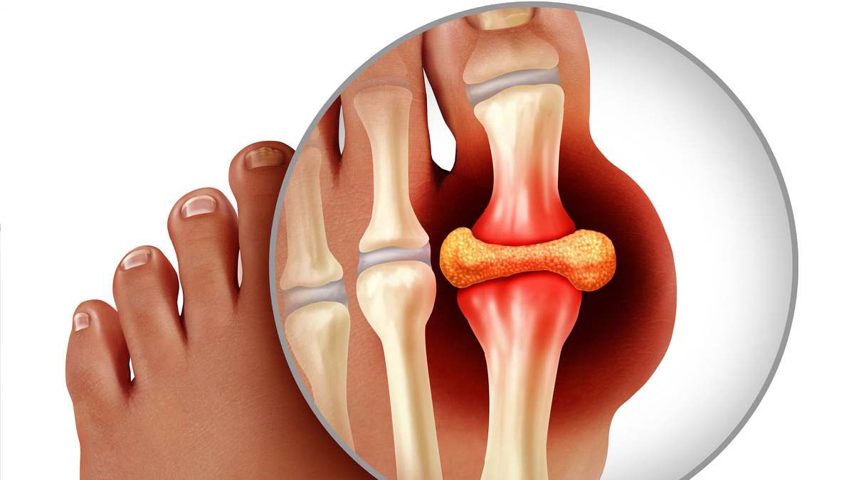 Pain and headache among Uric Acid increase symptoms