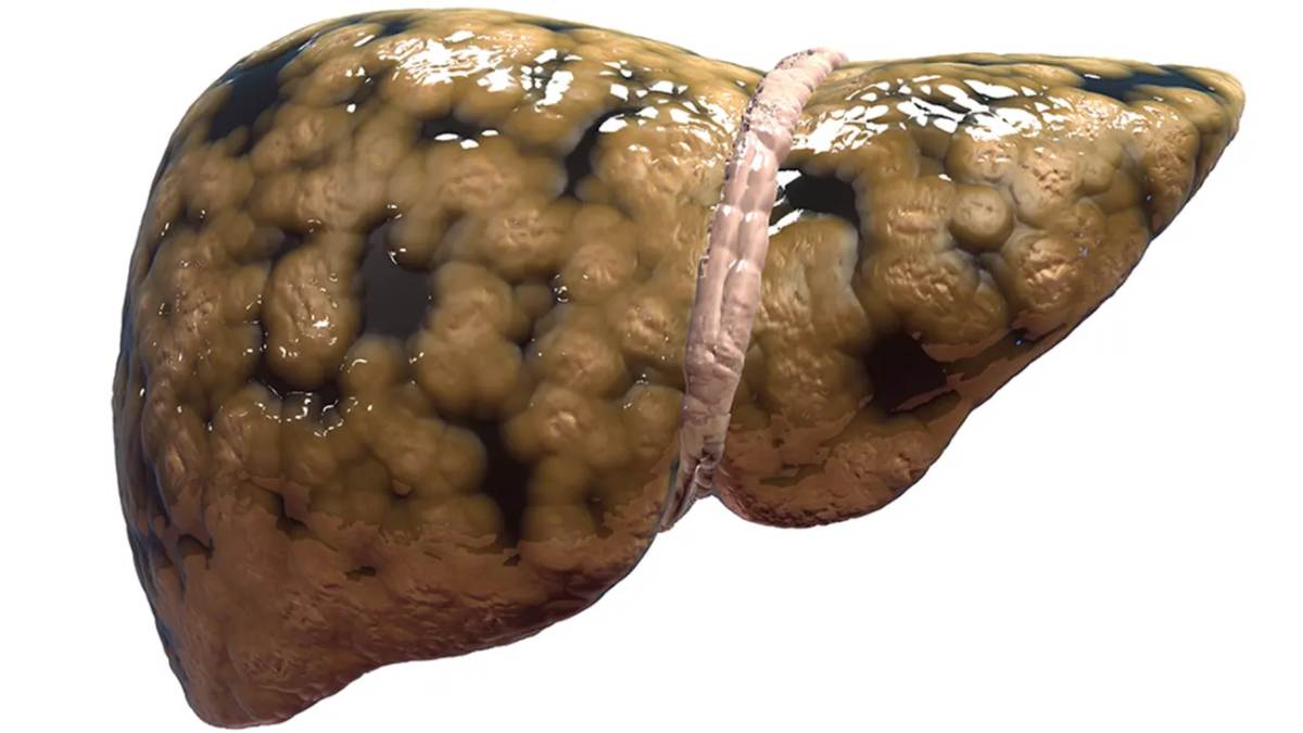 Liver Cancer Symptoms can sometimes be similar to Gas and Bloating